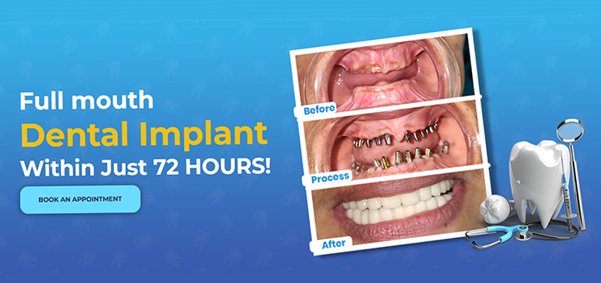 Full mouth dental Implant in 72 Hours using Advanced German Technology by Dr. Vishwannath Hiremath, Bangalore.